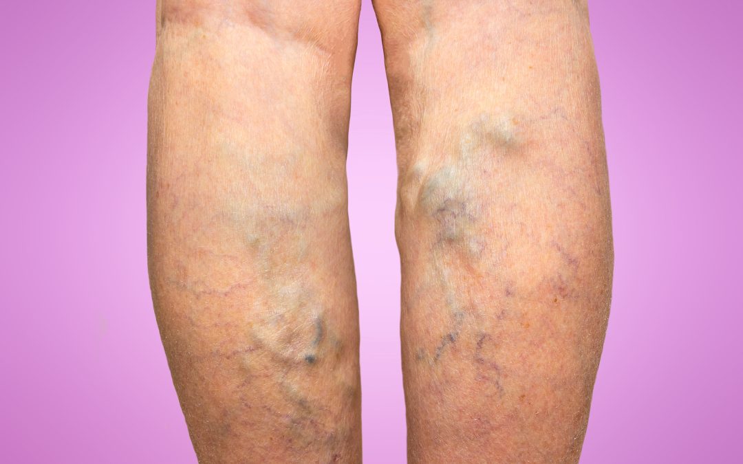 Learn the warning signs of Deep Vein Thrombosis in Warrenton, VA, and protect your health