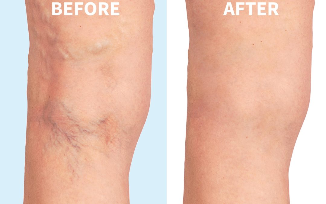 Find Effective Solutions Through Varicose Veins Treatment in Virginia Beach, VA