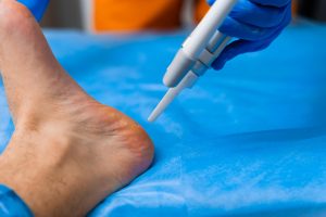 Get Back on Your Feet With Achilles Tendonitis Treatment in Chester, VA
