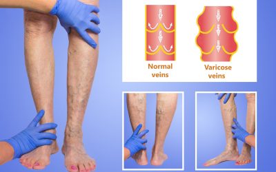 Important Facts About Deep Vein Thrombosis in Petersburg, VA Shared by Professionals