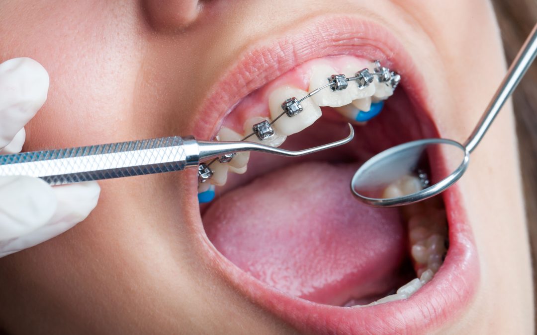 The Long-Term Benefits of a Dental Crown in Richland, WA for Lasting Tooth Protection