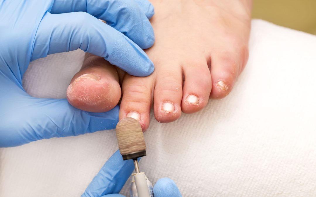 How a Toe Nail Doctor in Concord, CA Can Help You Overcome Persistent Ingrown Toenails Fast