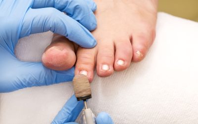 How a Toe Nail Doctor in Concord, CA Can Help You Overcome Persistent Ingrown Toenails Fast